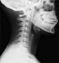 Whiplash Injury X-Ray