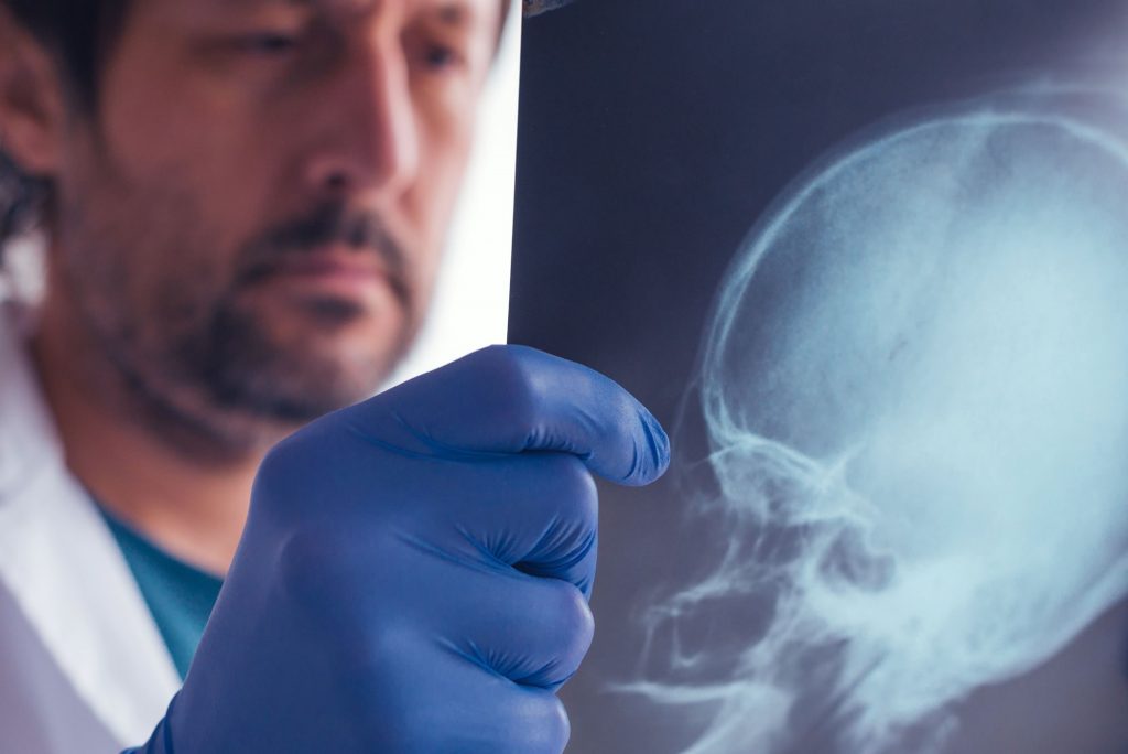 examining x-ray of skull - brain/head injury claim compensation Bristol